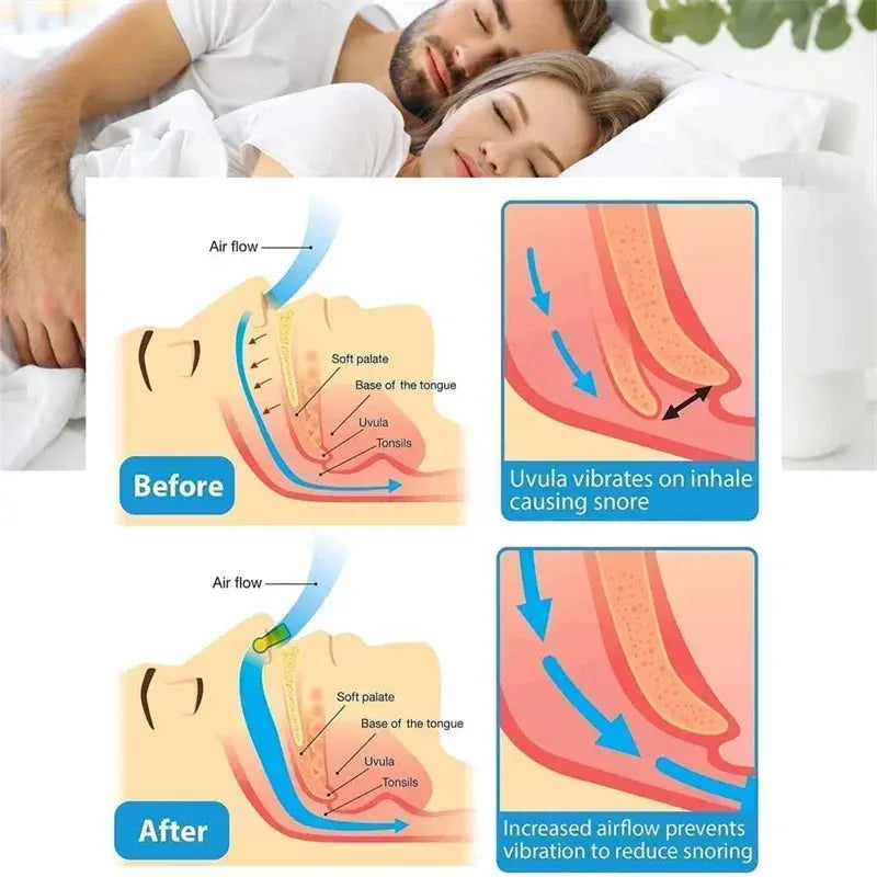 Anti-Snoring Nose Clip Snoring Prevention Solution